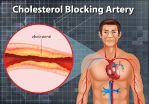 High cholesterol